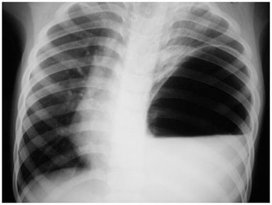 Case Report: Late-Presenting Congenital Diaphragmatic Hernia With Tension Gastrothorax